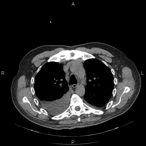 File:Non Hodgkin lymphoma in a patient with ankylosing spondylitis (Radiopaedia 84323-99624 Axial non-contrast 13).jpg