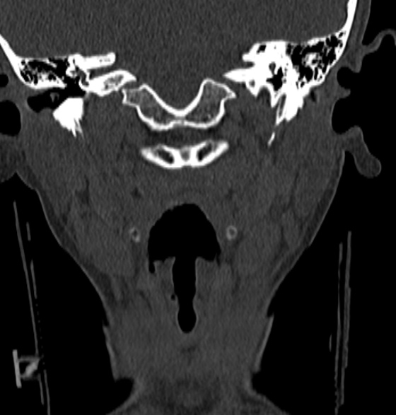 File:Normal CT cervical spine - 12-year-old (Radiopaedia 55352-61775 Coronal bone window 31).jpg