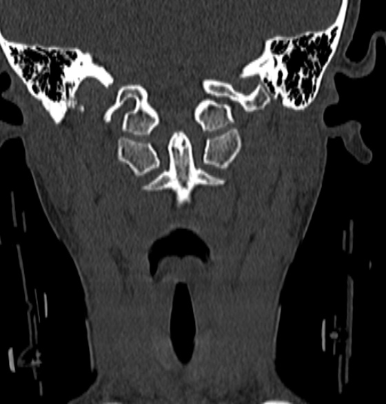 File:Normal CT cervical spine - 12-year-old (Radiopaedia 55352-61775 Coronal bone window 49).jpg