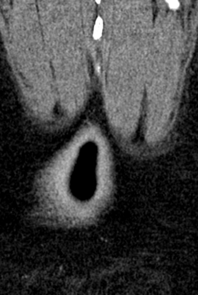 Normal CT lumbar spine (Radiopaedia 53981-60118 F 107).jpg