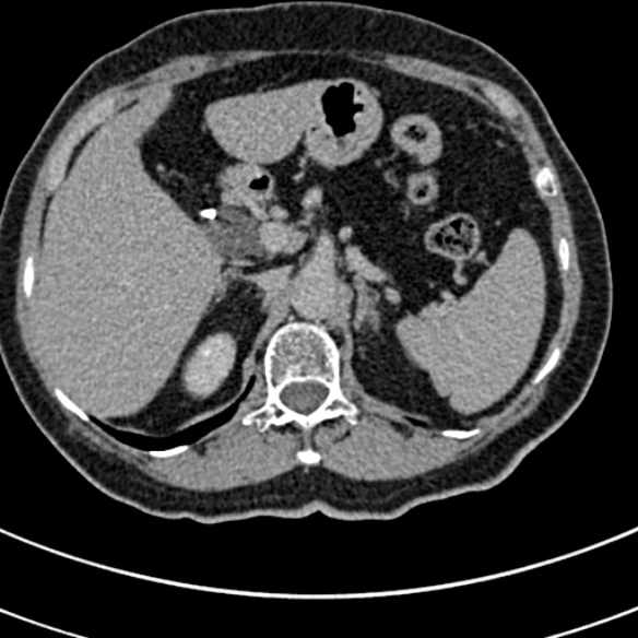 File:Normal CT split bolus study of the renal tract (Radiopaedia 48631-53634 Axial split bolus 24).jpg