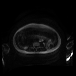 Normal MRI abdomen in pregnancy (Radiopaedia 88001-104541 Axial DWI 112).jpg