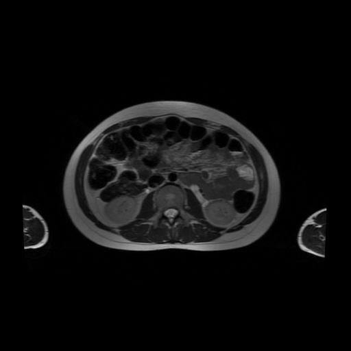 File:Normal MRI abdomen in pregnancy (Radiopaedia 88001-104541 Axial T2 30).jpg