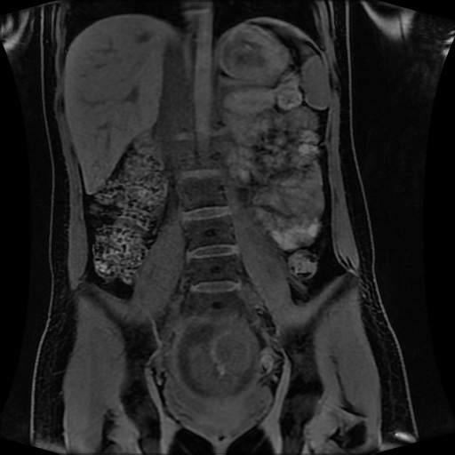 Normal MRI abdomen in pregnancy (Radiopaedia 88001-104541 M 82).jpg