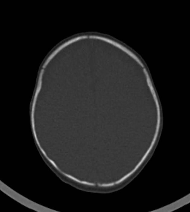 Normal brain CT - 2-month-old (Radiopaedia 53369-59350 Axial bone window 16).jpg