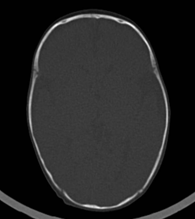Normal brain CT - 2-month-old (Radiopaedia 53369-59350 Axial bone window 32).jpg
