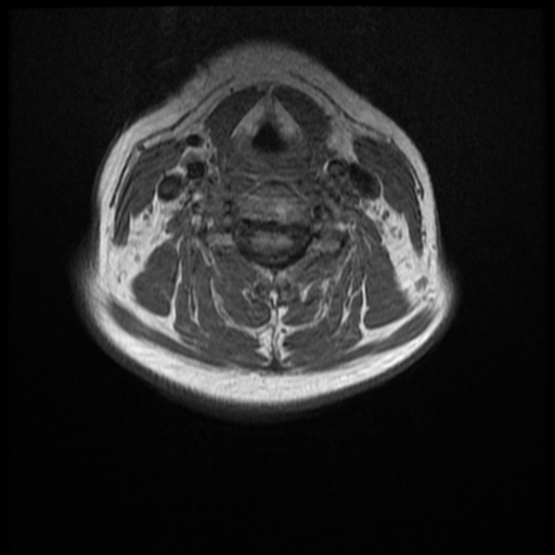 File:Normal cervical and thoracic spine MRI (Radiopaedia 35630-37156 Axial T1 18).png