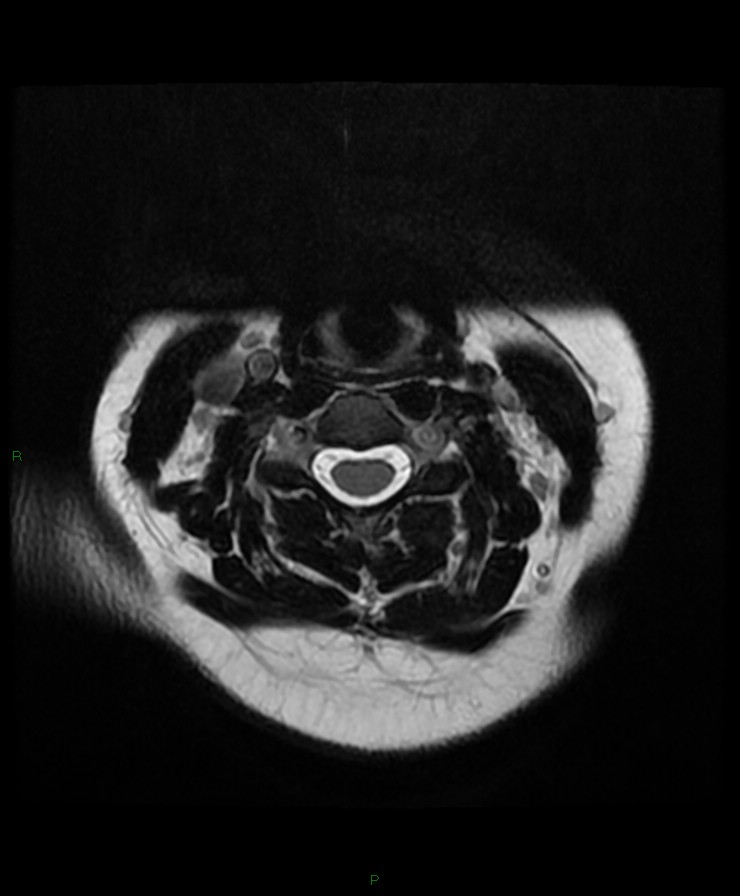 Normal cervical spine MRI (Radiopaedia 80146-93454 Axial T2 38).jpg
