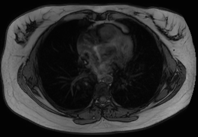 File:Normal liver MRI with Gadolinium (Radiopaedia 58913-66163 B 35).jpg