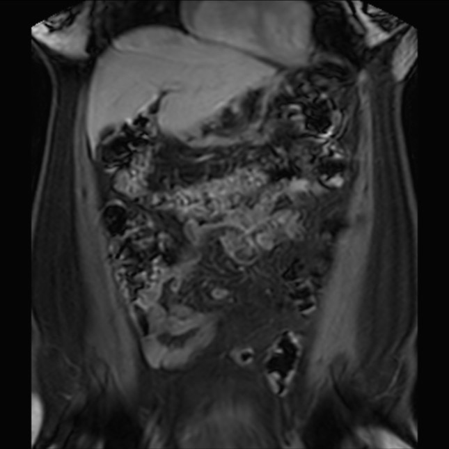Normal liver MRI with Gadolinium (Radiopaedia 58913-66163 P 27).jpg