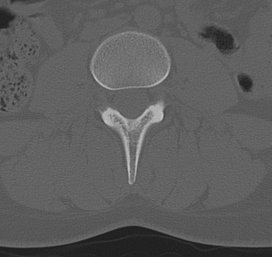 File:Normal lumbar spine CT (Radiopaedia 46533-50986 Axial bone window 38).png
