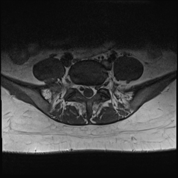 File:Normal lumbar spine MRI- 3 T (Radiopaedia 53280-59250 Axial 27).jpg