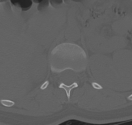 File:Normal lumbosacral CT (Radiopaedia 37923-39867 Axial bone window 25).png