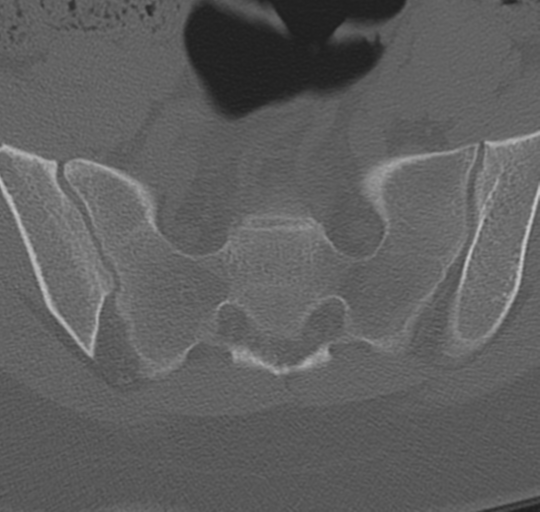 File:Normal lumbosacral CT (Radiopaedia 37923-39867 Axial bone window 89).png