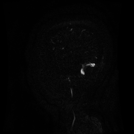 Normal noncontrast MR venography (Radiopaedia 87578-103957 A 150).jpg