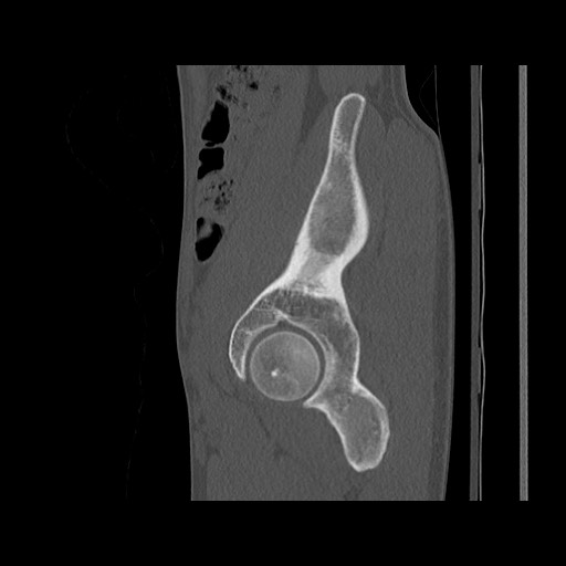 Normal pelvis (Radiopaedia 51473-57238 Sagittal bone window 41).jpg