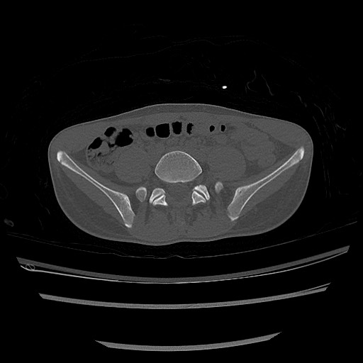 Normal pelvis CT (Radiopaedia 51471-57236 Axial bone window 14).jpg
