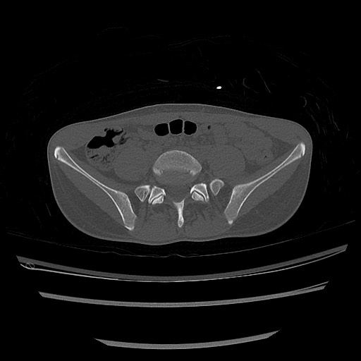 Normal pelvis CT (Radiopaedia 51471-57236 Axial bone window 16).jpg