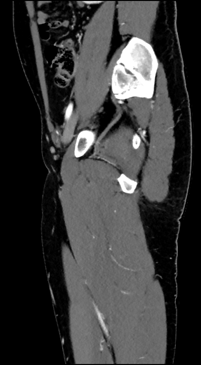 Normal pelvis CT angiogram (Radiopaedia 84966-100481 C 38).jpg