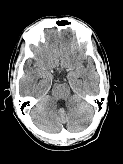 Normal trauma protocol brain and C-spine CT (Radiopaedia 83302-97709 Axial non-contrast 50).jpg