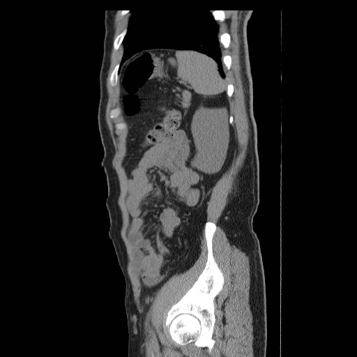 File:Obstructed kidney with perinephric urinoma (Radiopaedia 26889-27066 B 52).jpg