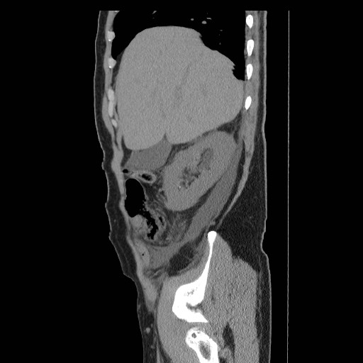 File:Obstructed kidney with perinephric urinoma (Radiopaedia 26889-27066 B 7).jpg