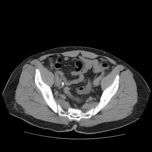 File:Obstructed kidney with perinephric urinoma (Radiopaedia 26889-27067 Axial non-contrast 43).jpg