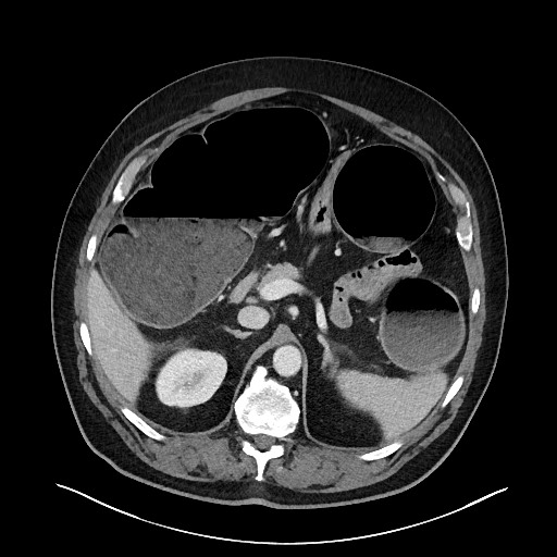 File:Obstructing sigmoid adenocarcinoma (Radiopaedia 58465-65619 A 51).jpg