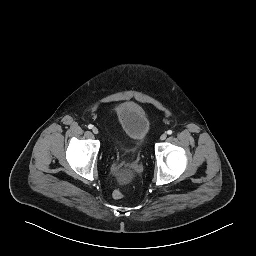 File:Obstructing sigmoid adenocarcinoma (Radiopaedia 58465-65619 Axial 112).jpg