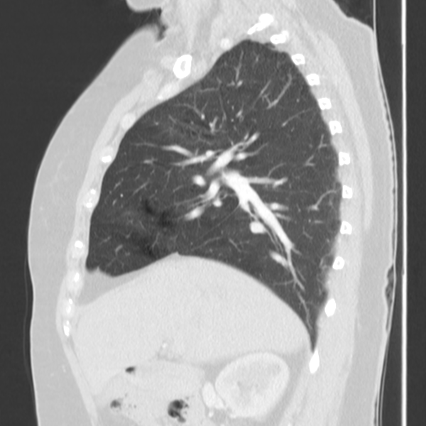 Obstructing typical carcinoid causing bronchoceles (Radiopaedia 50149-55476 Sagittal lung window 21).png