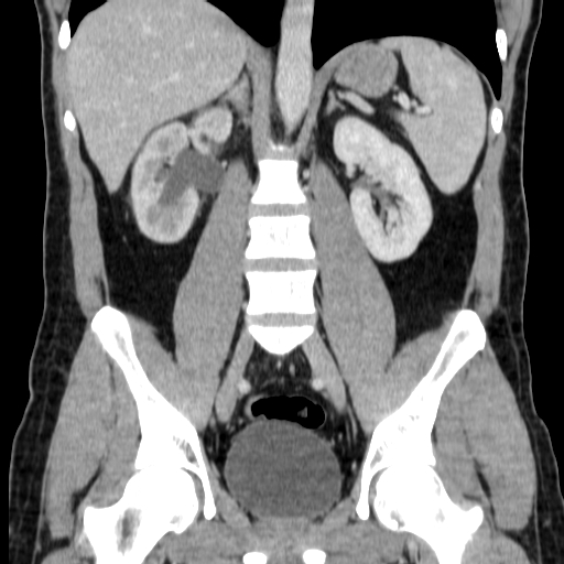 File:Obstructing ureteric calculus (Radiopaedia 18615-18514 C 46).jpg