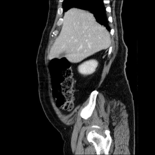 Obstructing ureteric calculus (Radiopaedia 49281-54373 C 72).jpg