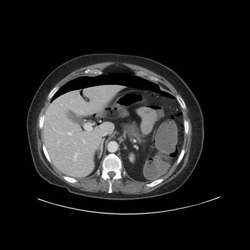 Obstructive distal colonic adenocarcinoma causing cecal perforation (Radiopaedia 86830-102989 A 52).jpg