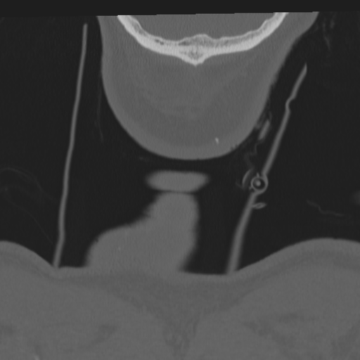 File:Occipital condyle fracture (Radiopaedia 33467-34517 Coronal bone window 84).png