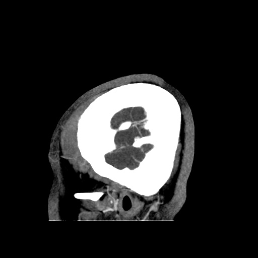 Occipital extradural hematoma simulating venous sinus thrombosis (Radiopaedia 46514-50964 D 72).jpg