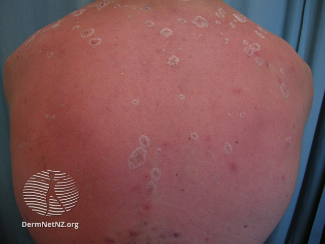 File:Peeling after sunburn (DermNet NZ reactions-sunburn4).jpg