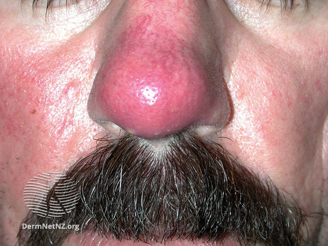 Rosacea (DermNet NZ acne-red-face-3646).jpg
