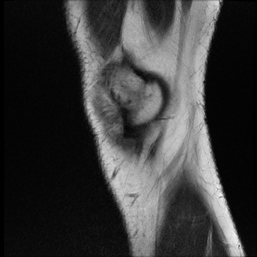 File:ACL acute full thickness tear - deep lateral femoral sulcus sign (Radiopaedia 38594-40740 Sagittal T2 1).jpg
