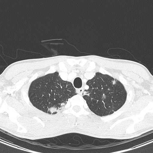 AIDS-related Kaposi sarcoma (Radiopaedia 85247-100811 Axial lung window 24).jpg