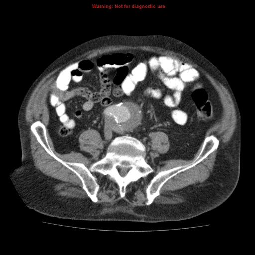 Abdominal aortic aneurysm (Radiopaedia 10122-10660 Axial C+ portal venous phase 54).jpg