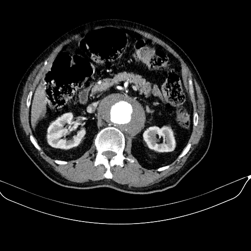 Abdominal aortic aneurysm (Radiopaedia 67117-76452 Axial C+ arterial phase 50).jpg