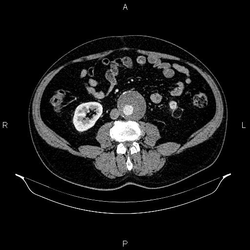 File:Abdominal aortic aneurysm (Radiopaedia 83094-97462 Axial renal cortical phase 108).jpg