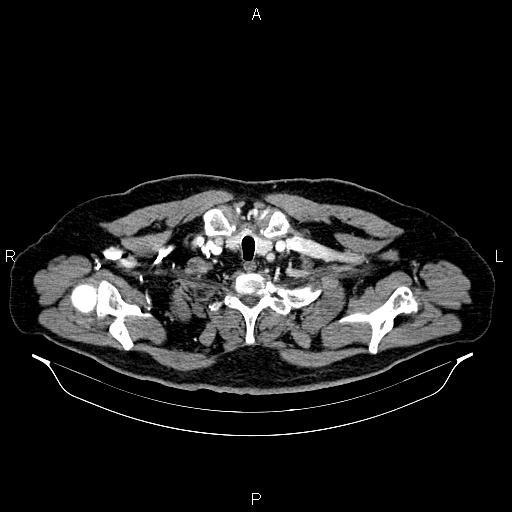 Abdominal aortic aneurysm (Radiopaedia 83094-97462 Axial renal cortical phase 7).jpg