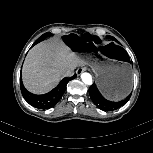 Abdominal aortic aneurysm (Radiopaedia 83581-98689 Axial C+ arterial phase 19).jpg