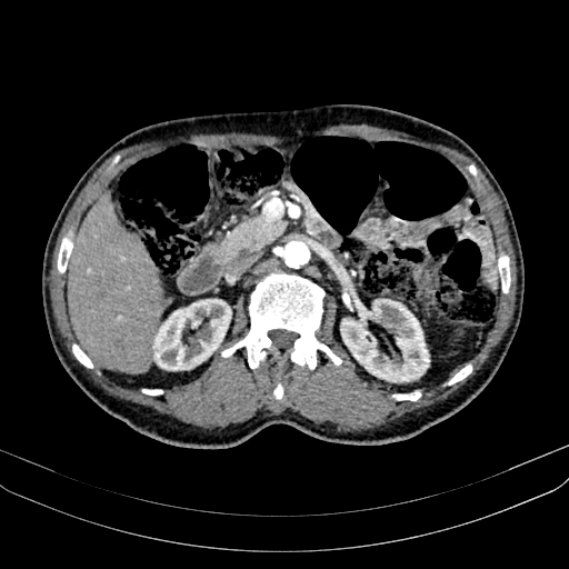 Abdominal aortic aneurysm (Radiopaedia 83581-98689 Axial C+ arterial phase 47).jpg