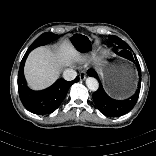 Abdominal aortic aneurysm (Radiopaedia 83581-98689 Axial C+ portal venous phase 12).jpg