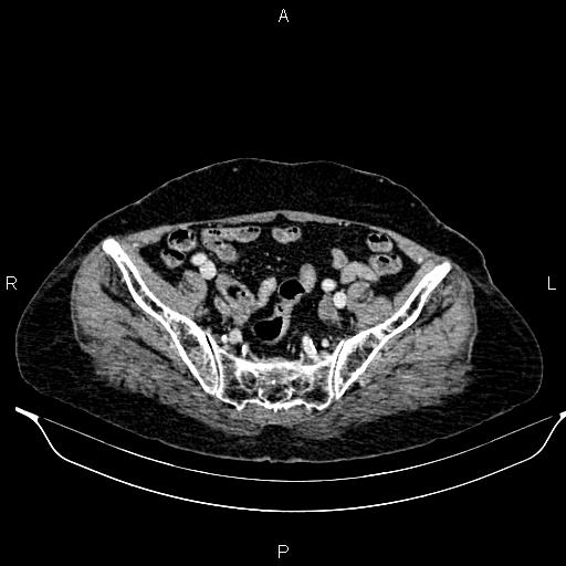 File:Abdominal aortic aneurysm (Radiopaedia 85063-100606 Axial C+ portal venous phase 57).jpg