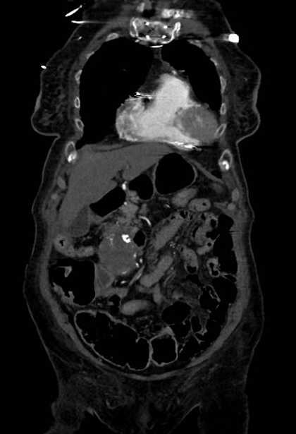 Abdominal aortic aneurysm with thrombus fissuration (Radiopaedia 73192-83919 Coronal C+ arterial phase 11).jpg