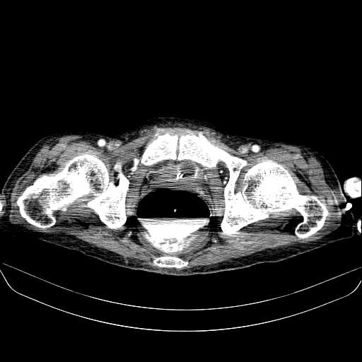 File:Abdominal collection due to previous cecal perforation (Radiopaedia 80831-94320 Axial C+ portal venous phase 203).jpg