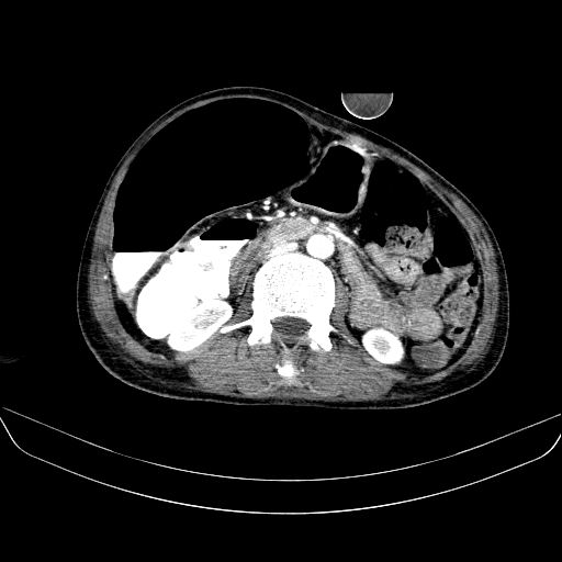 File:Abdominal collection due to previous cecal perforation (Radiopaedia 80831-94320 Axial C+ portal venous phase 95).jpg